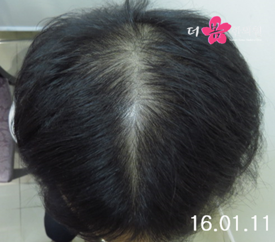 치료 후 사진입니다.