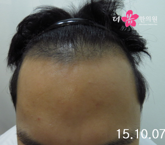 치료 전 사진입니다.