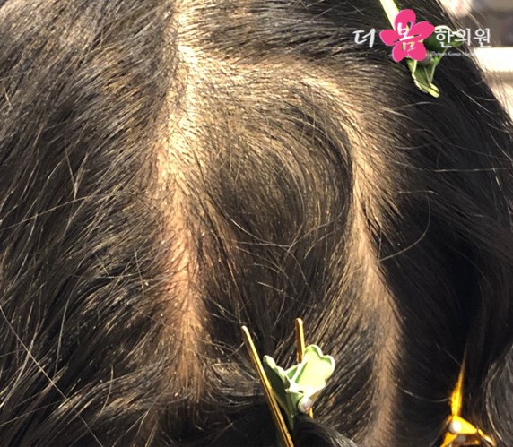 치료 후 사진입니다.