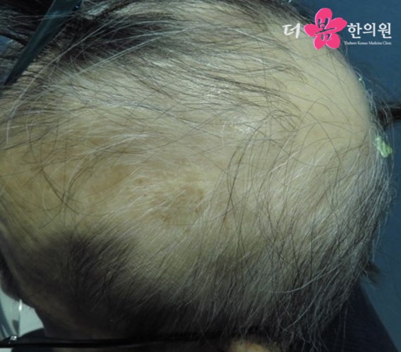 치료 전 사진입니다.